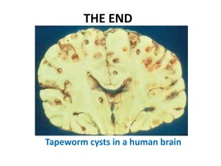 THE END

Tapeworm cysts in a human brain

 