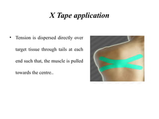 X Tape application
• Tension is dispersed directly over
target tissue through tails at each
end such that, the muscle is pulled
towards the centre..
 