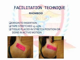 FACILITATION TECHNIQUE
RHOMBOID
ORIGINTO INSERTION
TAPE STRETCHED 15-25%
TISSUE PLACED IN STRETCH POSITION OR
DONE IN ACTIVE MOTION
 