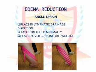 EDEMA REDUCTION
ANKLE SPRAIN
PLACE IN LYMPHATIC DRAINAGE
DIRECTION
TAPE STRETCHED MINIMALLY
PLACED OVER BRUISING OR SWELLING
 