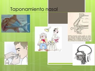 Taponamiento nasal
 