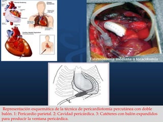 RX: ENSANCHAMIENTO SILUETA CARDIACA