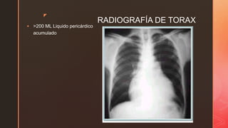 z
RADIOGRAFÍA DE TORAX
 >200 ML Liquido pericárdico
acumulado
 