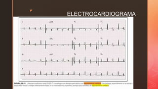z
ELECTROCARDIOGRAMA
 Alternancia eléctrica: que puede afectar cualquiera o todas las ondas o
solamente el QRS.
 Si QRS esta afectado, cualquier complejo QRS es mas pequeño, a
menudo con polaridad revertida
 