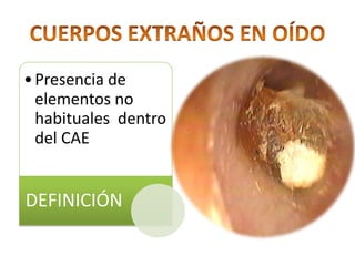 CUERPOS EXTRAÑOS EN OÍDO