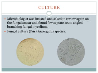 CULTURE
 Microbiologist was insisted and asked to review again on
the fungal smear and found few septate acute angled
branching fungal mycelium.
 Fungal culture (Pus):Aspergillus species.
 