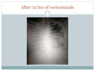 After 72 hrs of voriconazole
 