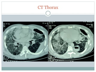 CT Thorax
 