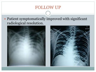 FOLLOW UP
 Patient symptomatically improved with significant
radiological resolution.
 