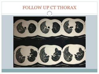 FOLLOW UP CT THORAX
 