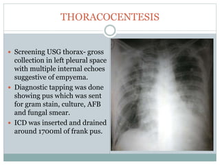 THORACOCENTESIS
 Screening USG thorax- gross
collection in left pleural space
with multiple internal echoes
suggestive of empyema.
 Diagnostic tapping was done
showing pus which was sent
for gram stain, culture, AFB
and fungal smear.
 ICD was inserted and drained
around 1700ml of frank pus.
 
