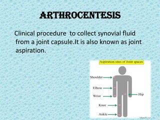 Arthrocentesis
Clinical procedure to collect synovial fluid
from a joint capsule.It is also known as joint
aspiration.
 
