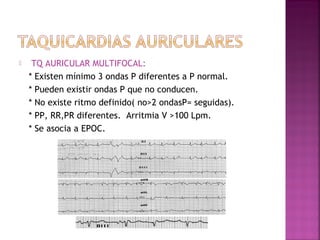  TQ AURICULAR MULTIFOCAL:
* Existen mínimo 3 ondas P diferentes a P normal.
* Pueden existir ondas P que no conducen.
* No existe ritmo definido( no>2 ondasP= seguidas).
* PP, RR,PR diferentes. Arritmia V >100 Lpm.
* Se asocia a EPOC.
 