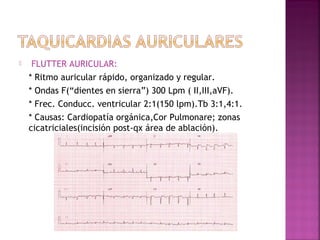  FLUTTER AURICULAR:
* Ritmo auricular rápido, organizado y regular.
* Ondas F(“dientes en sierra”) 300 Lpm ( II,III,aVF).
* Frec. Conducc. ventricular 2:1(150 lpm).Tb 3:1,4:1.
* Causas: Cardiopatía orgánica,Cor Pulmonare; zonas
cicatriciales(incisión post-qx área de ablación).
 