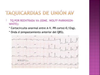  TQ POR REENTRADA VA (SDME. WOLFF-PARKINSON-
WHITE):
* Cortocircuito anormal entre A-V. PR corto(<0,12sg).
* Onda d (empastamiento anterior del QRS).
 
