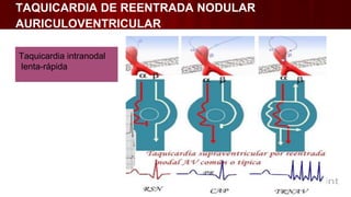 TAQUICARDIA DE REENTRADA NODULAR
AURICULOVENTRICULAR
Taquicardia intranodal
lenta-rápida
 