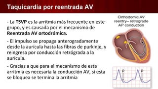 Taquicardia por reentrada AV
- La TSVP es la arritmia más frecuente en este
grupo, y es causada por el mecanismo de
Reentrada AV ortodrómica.
- El impulso se propaga anterogradamente
desde la aurícula hasta las fibras de purkinje, y
reingresa por conducción retrógrada a la
aurícula.
- Gracias a que para el mecanismo de esta
arritmia es necesaria la conducción AV, si esta
se bloquea se termina la arritmia
 