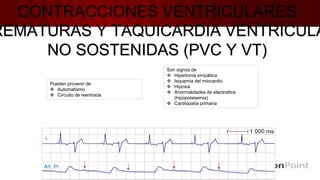 CONTRACCIONES VENTRICULARES
REMATURAS Y TAQUICARDIA VENTRICULA
NO SOSTENIDAS (PVC Y VT)
Pueden provenir de
 Automatismo
 Circuito de reentrada
Son signos de
 Hipertonía simpática
 Isquemia del miocardio
 Hipoxia
 Anormalidades de electrolitos
(hipopotasemia)
 Cardiopatía primaria
 