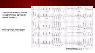 El sitio mas frecuente en que nacen las
arritmias ventriculares idiopáticas es el
infundíbulo de salida del ventrículo
derecho, origina PVC o VT.
La VT no sostenida regularmente es
monomorfa con frecuencia <200lpm
 