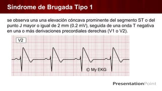 Síndrome de Brugada Tipo 1
se observa una una elevación cóncava prominente del segmento ST o del
punto J mayor o igual de 2 mm (0.2 mV), seguida de una onda T negativa
en una o más derivaciones precordiales derechas (V1 o V2).
 
