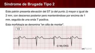 Síndrome de Brugada Tipo 2
Este patrón presenta elevación del ST (o del punto J) mayor o igual de
2 mm, con descenso posterior pero manteniéndose por encima de 1
mm, seguida de una onda T positiva.
Esta morfología se denomina "en silla de montar".
 