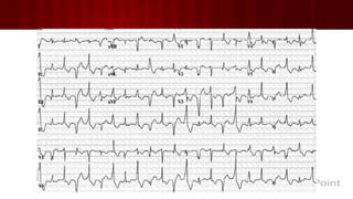 Tipos de Taquiarritmias