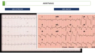 ARRITMIAS
QRS ESTRECHO QRS ANCHO
 