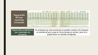 Taquicardia
SPV por
reentrada
intranodal
Taquicardia ortodrómica
por reentrada vía
accesoria
En ocasiones las vías accesorias no pueden conducir los impulsos
en sentido AV por lo que el ritmo sinusal es normal, pero si lo
puede hacer en sentido retrógrado.
 