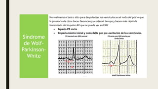 Síndrome
de Wolf-
Parkinson-
White
 
