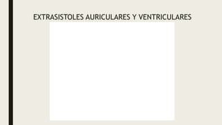 EXTRASISTOLES AURICULARES Y VENTRICULARES
 