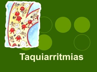 Taquiarritmias 