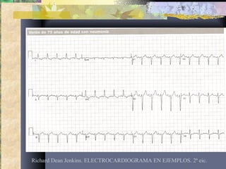 Richard Dean Jenkins. ELECTROCARDIOGRAMA EN EJEMPLOS. 2ª eic.
 