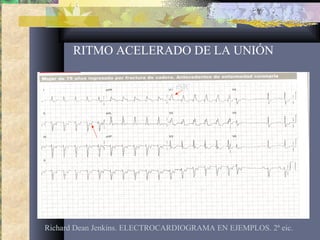 RITMO ACELERADO DE LA UNIÓN
Richard Dean Jenkins. ELECTROCARDIOGRAMA EN EJEMPLOS. 2ª eic.
rSR´
 