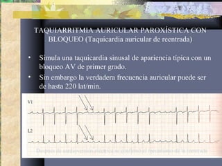 TAQUIARRITMIA AURICULAR PAROXÍSTICA CON
BLOQUEO (Taquicardia auricular de reentrada)
• Simula una taquicardia sinusal de apariencia típica con un
bloqueo AV de primer grado.
• Sin embargo la verdadera frecuencia auricular puede ser
de hasta 220 lat/min.
Después de cardioversión eléctrica se confirmó el mecanismo de la reentrada
 
