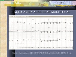 TAQUICARDIA AURICULAR MULTIFOCAL
Richard Dean Jenkins. ELECTROCARDIOGRAMA EN EJEMPLOS. 2ª eic.
 
