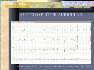 ALETEO O FLÚTER AURICULAR
Richard Dean Jenkins. ELECTROCARDIOGRAMA EN EJEMPLOS. 2ª edic
 