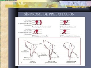 SÍNDROME DE PREEXITACIÓN
 