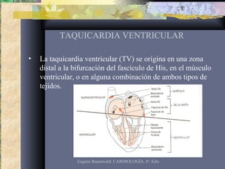 TAQUICARDIA VENTRICULAR
• La taquicardia ventricular (TV) se origina en una zona
distal a la bifurcación del fascículo de His, en el músculo
ventricular, o en alguna combinación de ambos tipos de
tejidos.
Eugene Braunwald. CARDIOLOGÍA. 6ª. Edic
 