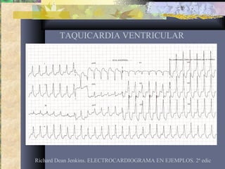 TAQUICARDIA VENTRICULAR
Richard Dean Jenkins. ELECTROCARDIOGRAMA EN EJEMPLOS. 2ª edic
 