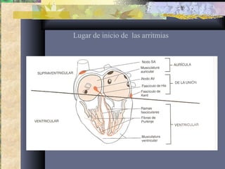 Lugar de inicio de las arritmias
 