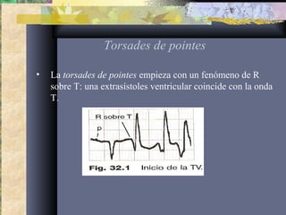 Torsades de pointes
• La torsades de pointes empieza con un fenómeno de R
sobre T: una extrasístoles ventricular coincide con la onda
T.
 