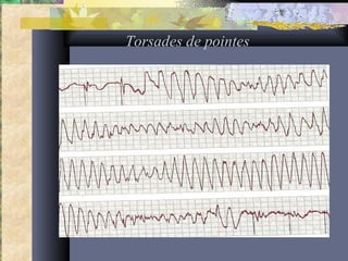 Torsades de pointes
 