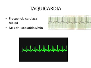 TAQUICARDIA
• Frecuencia cardiaca
rápida
• Más de 100 latidos/min
 