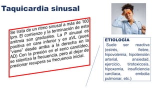 Taquicardia sinusal
ETIOLOGÍA
Suele ser reactiva
(estrés, fiebre,
hipovolemia, hipotensión
arterial, ansiedad,
ejercicio, tirotoxicosis,
hipoxemia, insuficiencia
cardíaca, embolia
pulmonar, etc.)
 