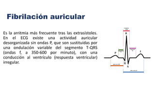 Fibrilación auricular
Es la arritmia más frecuente tras las extrasístoles.
En el ECG existe una actividad auricular
desorganizada sin ondas P, que son sustituidas por
una ondulación variable del segmento T-QRS
(ondas f, a 350-600 por minuto), con una
conducción al ventrículo (respuesta ventricular)
irregular.
 