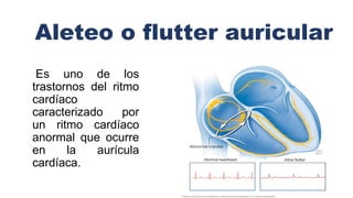 Aleteo o flutter auricular
Es uno de los
trastornos del ritmo
cardíaco
caracterizado por
un ritmo cardíaco
anormal que ocurre
en la aurícula
cardíaca.
 