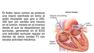 El flutter típico común se produce
una macro reentrada en torno al
anillo tricúspide que gira a 250-
350 lpm (en sentido anti horario
en el común, horario en el inverso)
desde el que se despolarizan las
aurículas, generando en el ECG
una actividad auricular regular en
dientes de sierra (ondas F) con
escasa actividad mecánica.
 