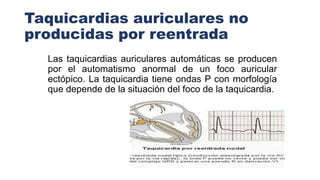 Taquicardias auriculares no
producidas por reentrada
Las taquicardias auriculares automáticas se producen
por el automatismo anormal de un foco auricular
ectópico. La taquicardia tiene ondas P con morfología
que depende de la situación del foco de la taquicardia.
 