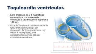 Taquicardia ventricular.
• Es la presencia de 3 ó más latidos
consecutivos procedentes del
ventrículo, a una frecuencia superior a
100 lpm.
• En el ECG aparece una taquicardia de
QRS ancho (≥0,12 seg), con
disociación AV (ocasionalmente hay
ondas P retrógradas), que
generalmente se inicia con un
extrasístole ventricular.
 