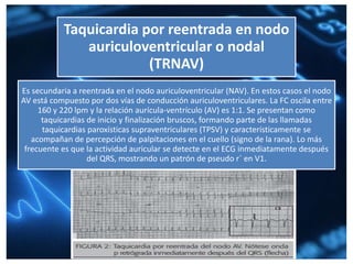 Taquicardia por reentrada en nodo
auriculoventricular o nodal
(TRNAV)
Es secundaria a reentrada en el nodo auriculoventricular (NAV). En estos casos el nodo
AV está compuesto por dos vías de conducción auriculoventriculares. La FC oscila entre
160 y 220 lpm y la relación aurícula-ventrículo (AV) es 1:1. Se presentan como
taquicardias de inicio y finalización bruscos, formando parte de las llamadas
taquicardias paroxísticas supraventriculares (TPSV) y característicamente se
acompañan de percepción de palpitaciones en el cuello (signo de la rana). Lo más
frecuente es que la actividad auricular se detecte en el ECG inmediatamente después
del QRS, mostrando un patrón de pseudo r` en V1.
 